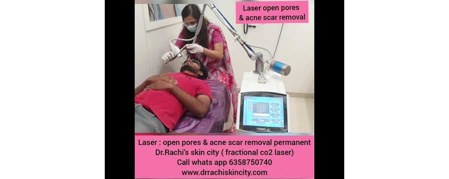 laser for open pores & acne scar