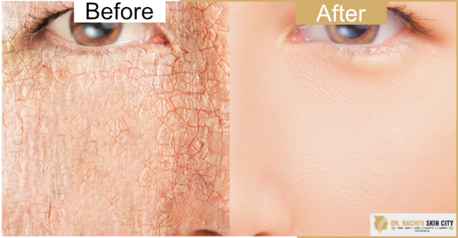 Dr Rachi S Skin City Skin Dryness Treatment Dry Skin Treatment